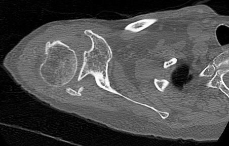 Figure 2 for case Greater tuberosity avulsion fracture